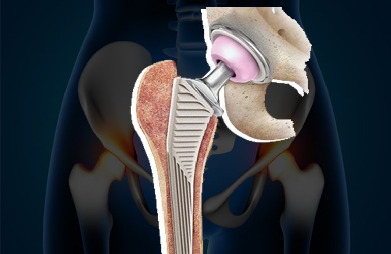 Revision Joint Replacement