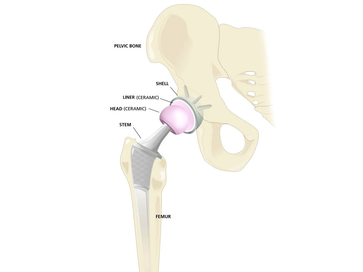 Hip Replacement