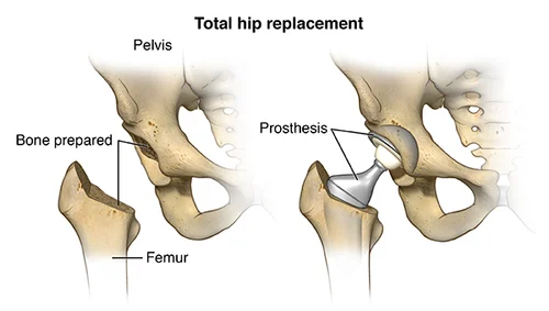 Hip Replacement Surgery